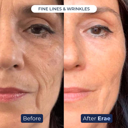 Erae™ Bio-Infusion