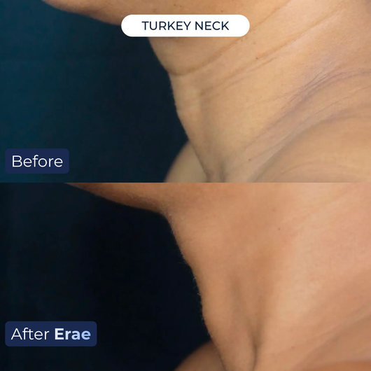 Erae™ Bio-Infusion